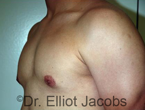 Men's breast, before Gynecomastia Adolescent treatment, oblique view - patient 31