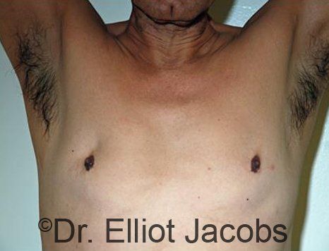Men's breast, before Revision Gynecomastia treatment, front view - patient 1
