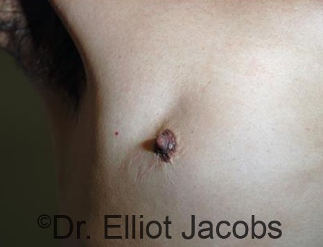 Men's nipple, before Revision Gynecomastia treatment, front view - patient 1