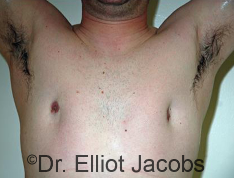 Men's breast, before Revision Gynecomastia treatment, front view - patient 2