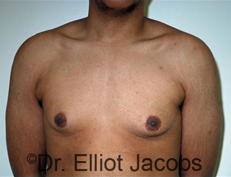 Male breast, before Gynecomastia treatment, front view, patient 87