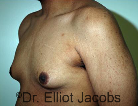 Male breast, before Gynecomastia treatment, l-side oblique view - patient 87