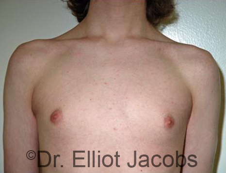 Men's breast, before Gynecomastia Adolescent treatment, front view - patient 32