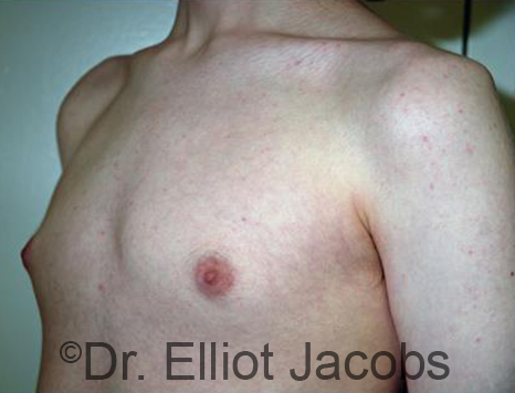 Men's breast, before Gynecomastia Adolescent treatment, oblique view - patient 32