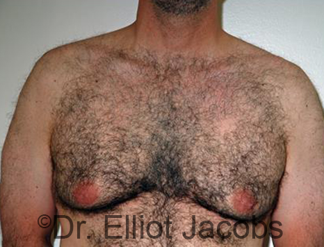 Male breast, before Gynecomastia treatment, front view, patient 88