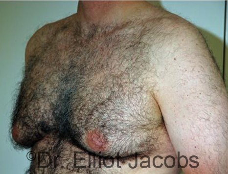 Male breast, before Gynecomastia treatment, l-side oblique view - patient 88