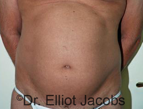 Male body, before Puffy Nipple Reduction treatment, front view, patient 3