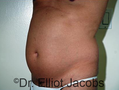 Male body, before Torsoplasty treatment, l-side oblique view, patient 25