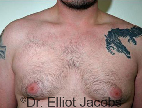 Male breast, before Gynecomastia treatment, front view, patient 24