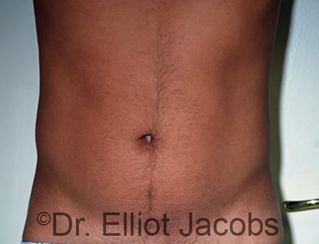 Male body, before Torsoplasty treatment, front view - patient 26