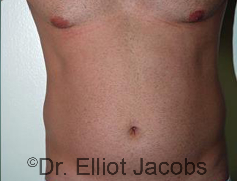 Male body, before Torsoplasty treatment, front view, patient 27