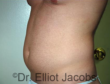 Male body, before Torsoplasty treatment, l-side oblique view, patient 27