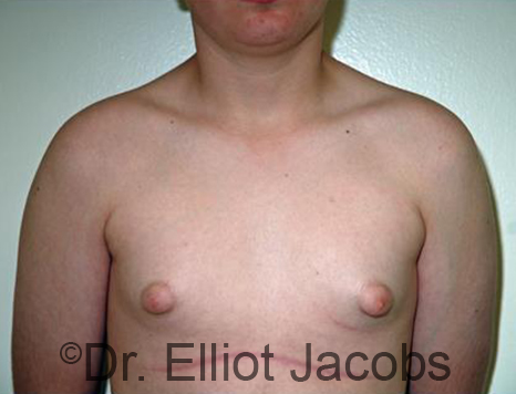 Men's breast, before Gynecomastia Adolescent treatment, front view - patient 33