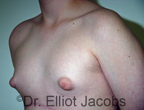 Men's breast, before Gynecomastia Adolescent treatment, oblique view - patient 33