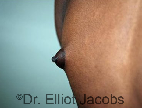 Male nipple, before Puffy Nipple treatment, r-side oblique view - patient 29