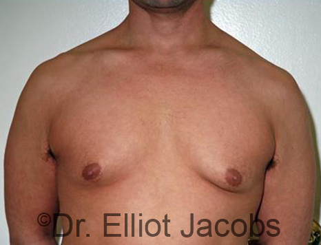 Male breast, before Gynecomastia treatment, front view, patient 89