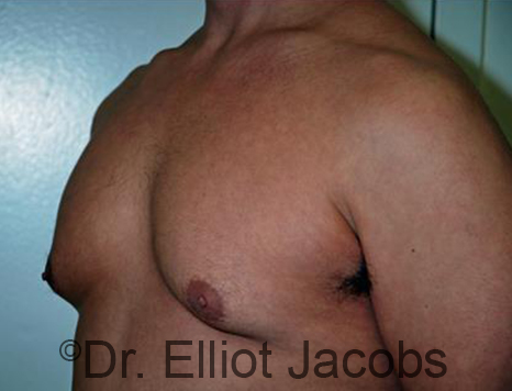 Male breast, before Gynecomastia treatment, l-side oblique view - patient 89