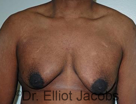 Male breast, before Gynecomastia treatment, front view, patient 90