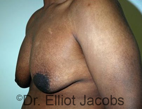 Male breast, before Gynecomastia treatment, l-side oblique view - patient 90