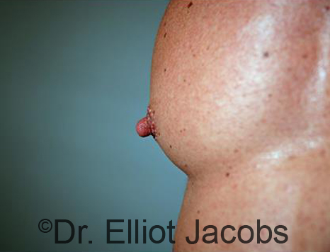 Male nipple, before Puffy Nipple treatment, oblique view - patient 47