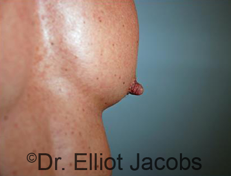 Male nipple, before Puffy Nipple treatment, side view - patient 47
