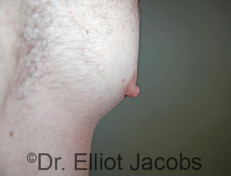 Male nipple, before Puffy Nipple treatment, side view - patient 48