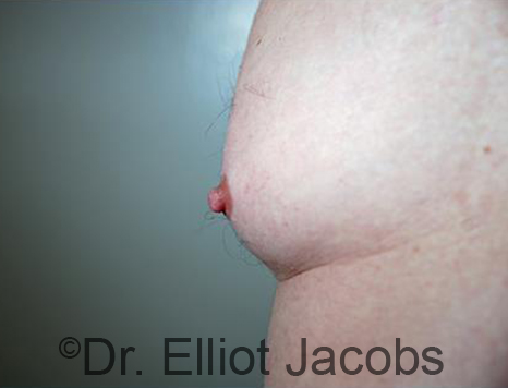 Male nipple, before Puffy Nipple treatment, oblique view - patient 49