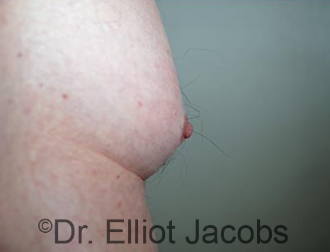 Male nipple, before Puffy Nipple treatment, side view - patient 49