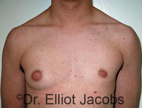 Men's breast, before Gynecomastia Adolescent treatment, front view - patient 34
