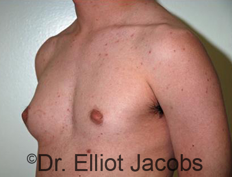 Men's breast, before Gynecomastia Adolescent treatment, oblique view - patient 34