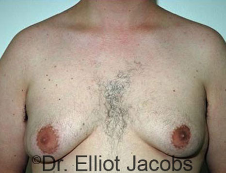 Male breast, before Gynecomastia treatment, front view, patient 25