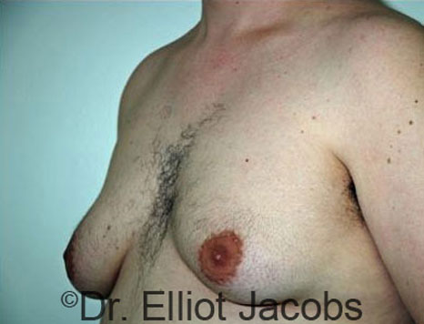 Male breast, before Gynecomastia treatment, l-side oblique view - patient 25