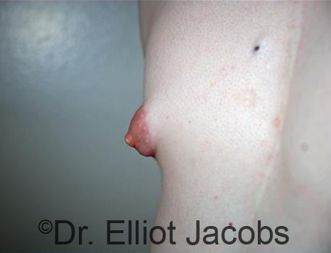 Male nipple, before Puffy Nipple treatment, r-side oblique view - patient 30