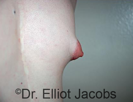 Male nipple, before Puffy Nipple treatment, l-side oblique view - patient 30