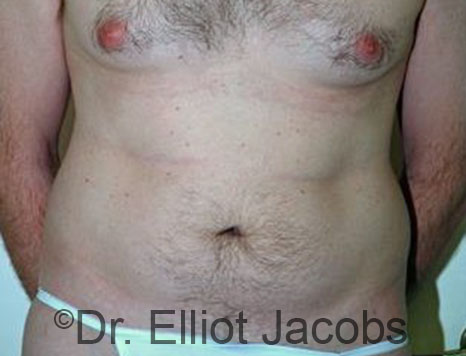 Male body, before Torsoplasty treatment, front view, patient 28