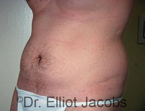 Male body, before Torsoplasty treatment, l-side oblique view, patient 28
