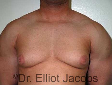 Male breast, before Gynecomastia treatment, front view, patient 91