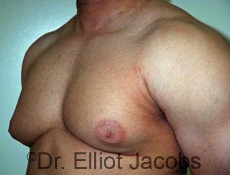 Male breast, before Gynecomastia treatment, l-side oblique view - patient 91