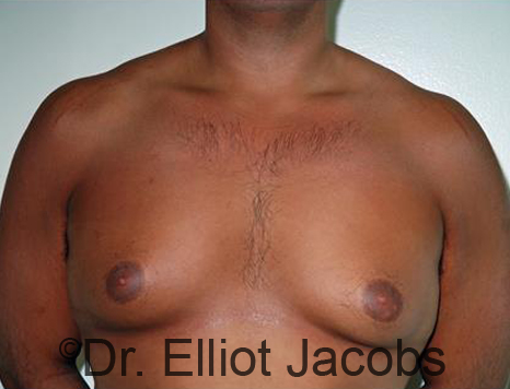 Male breast, before Gynecomastia treatment, front view, patient 92
