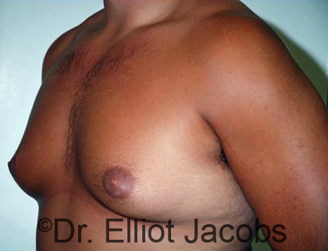 Male breast, before Gynecomastia treatment, l-side oblique view - patient 92