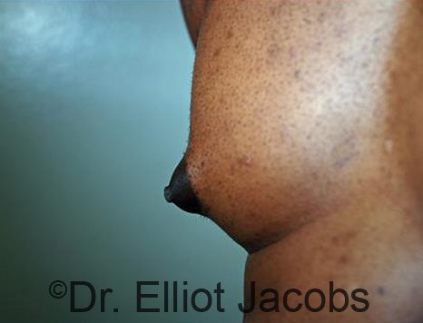 Male nipple, before Puffy Nipple treatment, r-side oblique view - patient 31