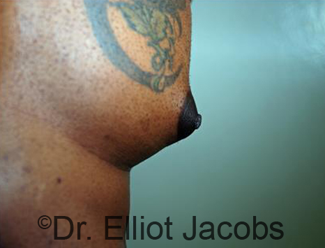 Male nipple, before Puffy Nipple treatment, l-side oblique view - patient 31