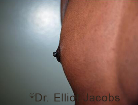 Male nipple, before Puffy Nipple treatment, oblique view - patient 50