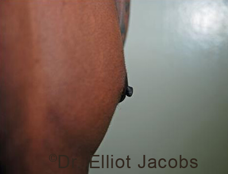 Male nipple, before Puffy Nipple treatment, side view - patient 50