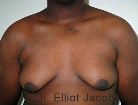 Male breast, before Gynecomastia treatment, front view, patient 93