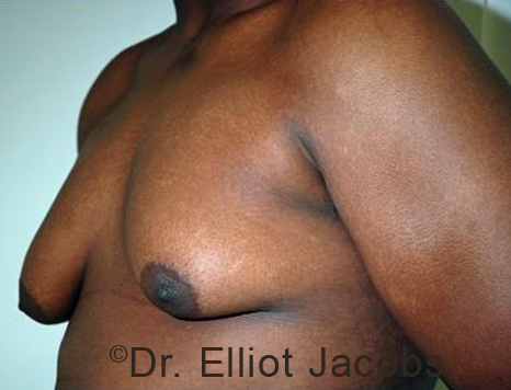 Male breast, before Gynecomastia treatment, l-side oblique view - patient 93