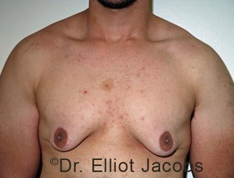 Male breast, before Gynecomastia treatment, front view, patient 94