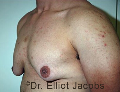 Male breast, before Gynecomastia treatment, l-side oblique view - patient 94