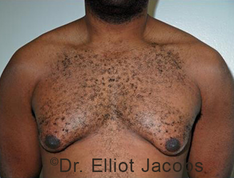 Male breast, before Gynecomastia treatment, front view, patient 95