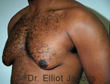 Male breast, before Gynecomastia treatment, l-side oblique view - patient 95